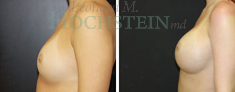 Breast Augmentation Patient