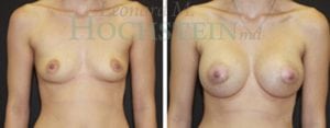 Breast Augmentation Patient