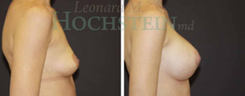 Breast Augmentation Patient