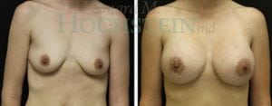 Breast Augmentation Patient