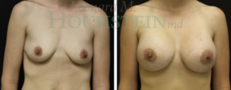 Breast Augmentation Patient
