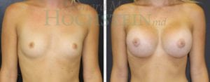 Breast Augmentation Patient