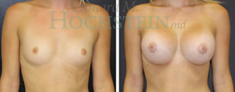 Breast Augmentation Patient