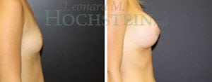 Breast Augmentation Patient