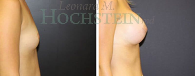 Breast Augmentation Patient