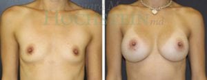 Breast Augmentation Patient