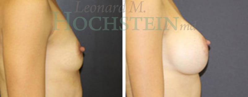 Breast Augmentation Patient