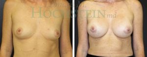 Breast Augmentation Patient