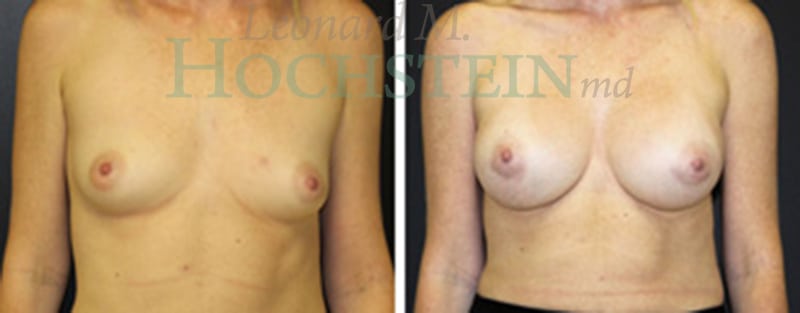 Breast Augmentation Patient