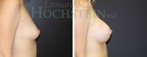 Breast Augmentation Patient