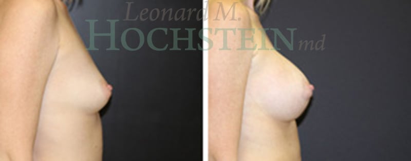Breast Augmentation Patient