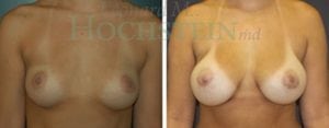 Breast Augmentation Patient