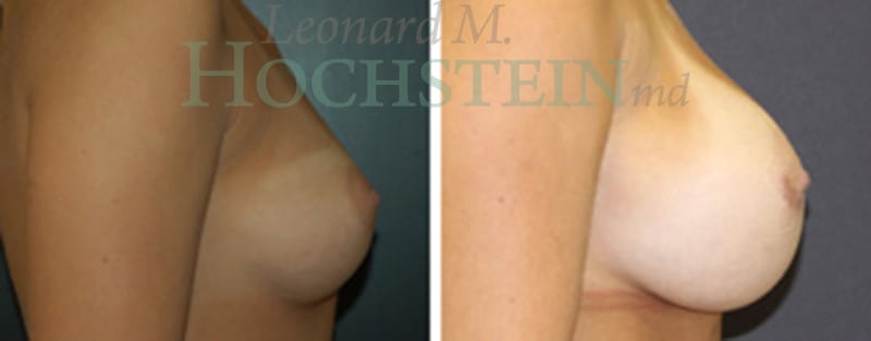 Breast Augmentation Patient