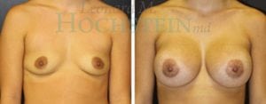 Breast Augmentation Patient