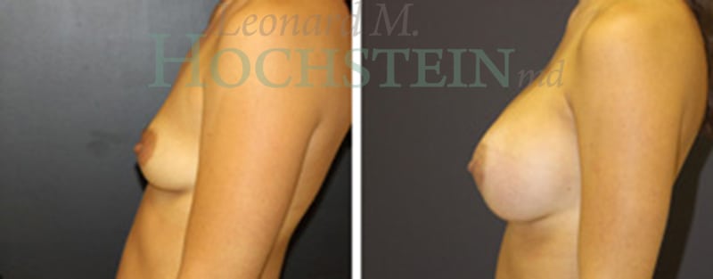 Breast Augmentation Patient