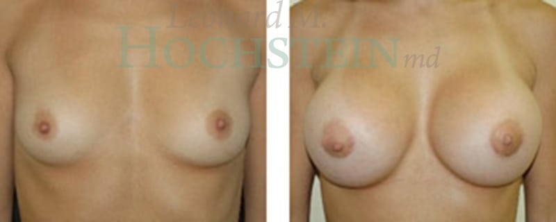 Breast Augmentation Patient