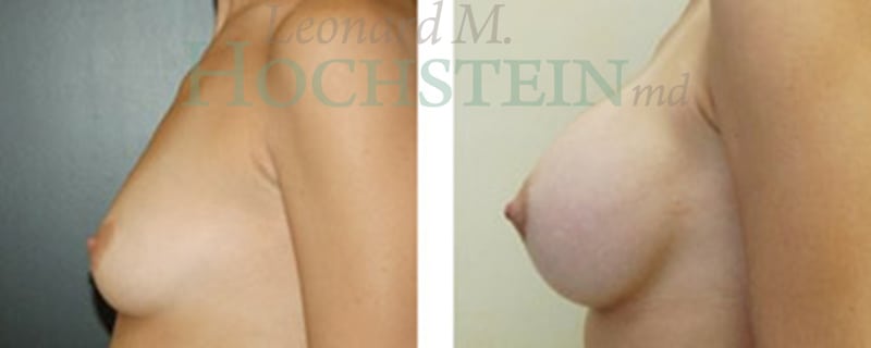 Breast Augmentation Patient