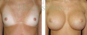 Breast Augmentation Patient