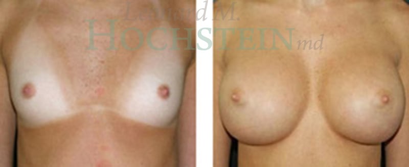 Breast Augmentation Patient