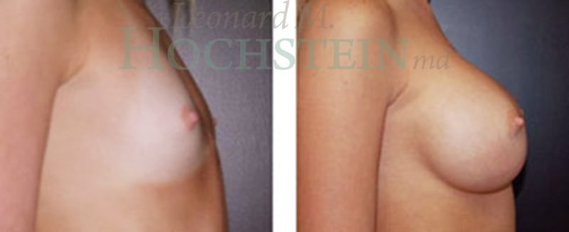 Breast Augmentation Patient