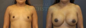 Breast Augmentation Patient