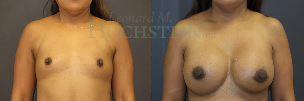 Breast Augmentation Patient