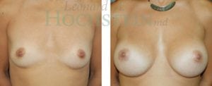 Breast Augmentation Patient