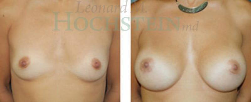 Breast Augmentation Patient