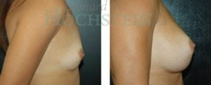 Breast Augmentation Patient