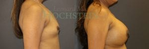 Breast Augmentation Patient