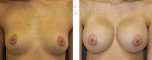 Breast Augmentation Patient