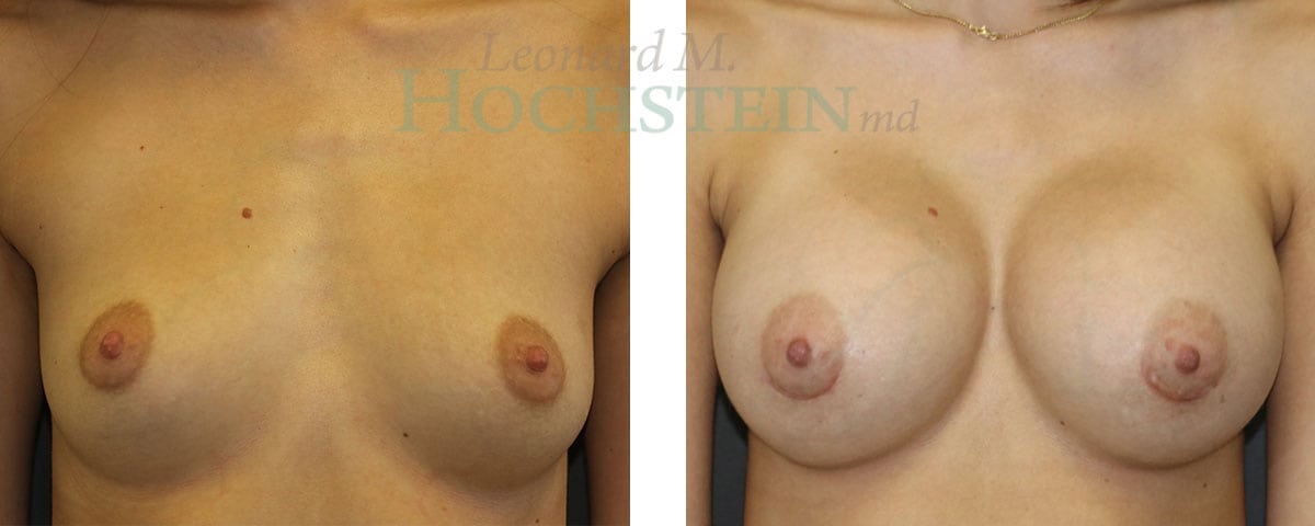 Breast Augmentation Patient