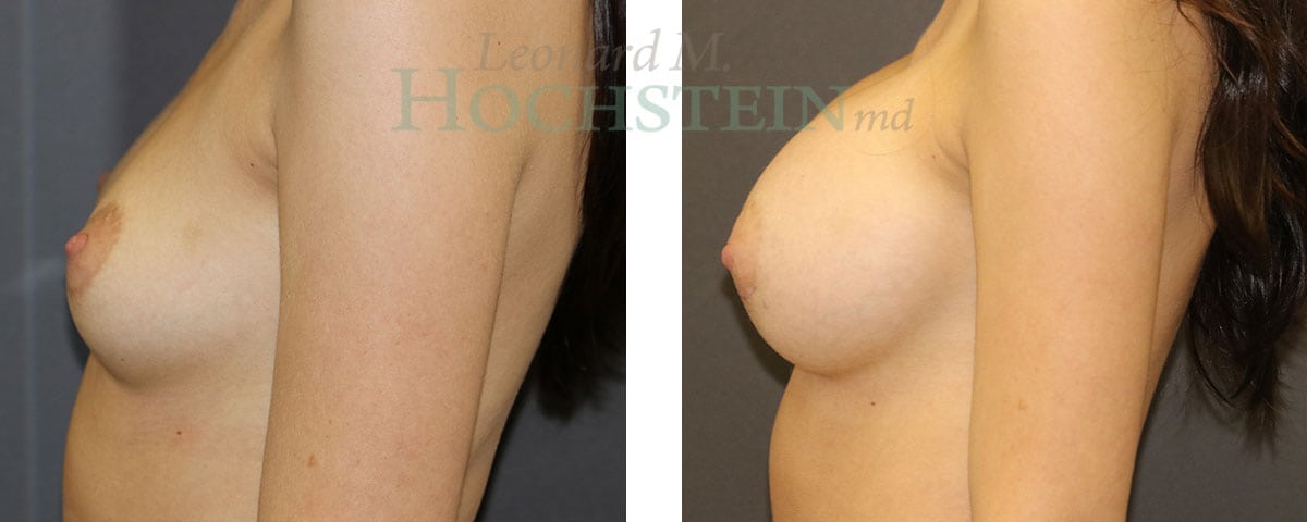 Breast Augmentation Patient