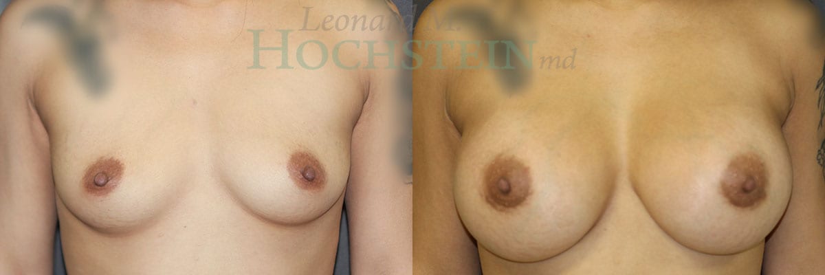 Breast Augmentation Patient