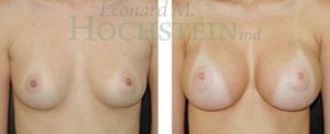 Breast Augmentation Patient