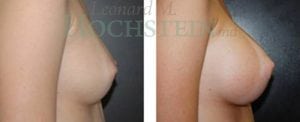 Breast Augmentation Patient