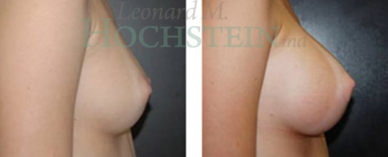 Breast Augmentation Patient