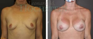 Breast Augmentation Patient 255