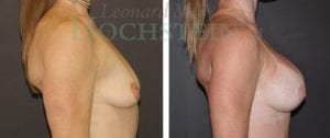 Breast Augmentation Patient