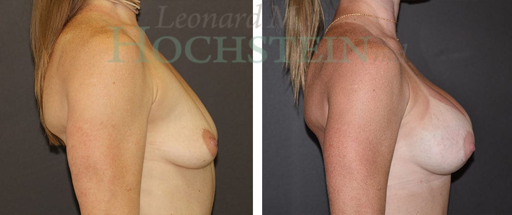 Breast Augmentation Patient