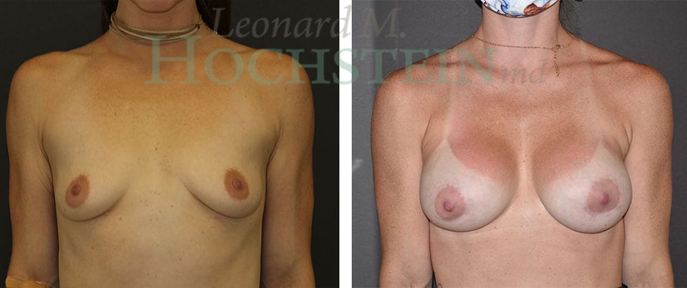 Breast Augmentation Patient