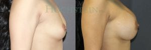 Breast Augmentation Patient