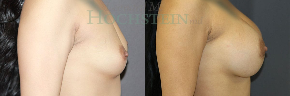 Breast Augmentation Patient