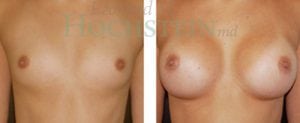 Breast Augmentation Patient