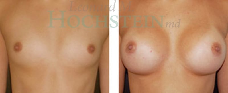 Breast Augmentation Patient