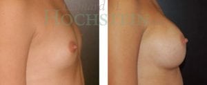 Breast Augmentation Patient