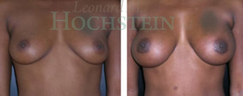 Breast Augmentation Patient