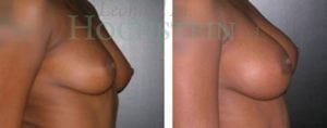 Breast Augmentation Patient