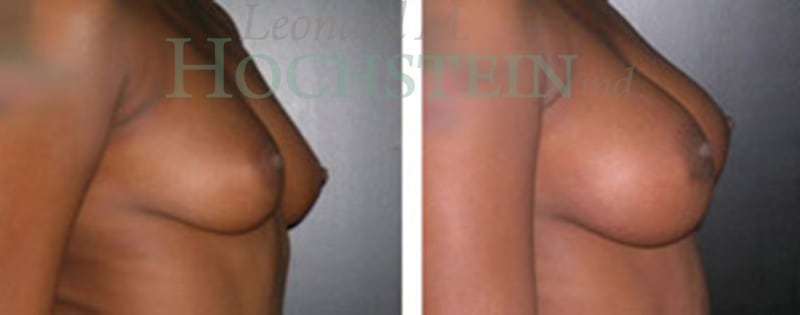 Breast Augmentation Patient