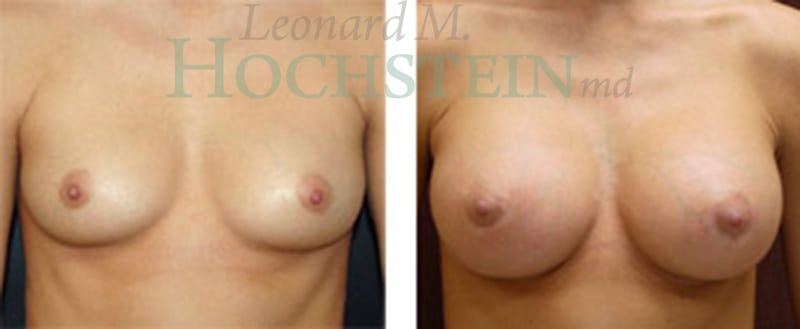 Breast Augmentation Patient